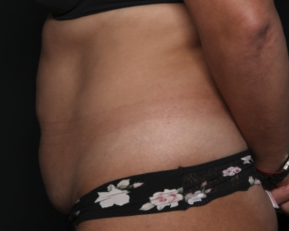 Liposuction Before & After Patient #36488