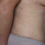 Tummy Tuck Before & After Patient #36585