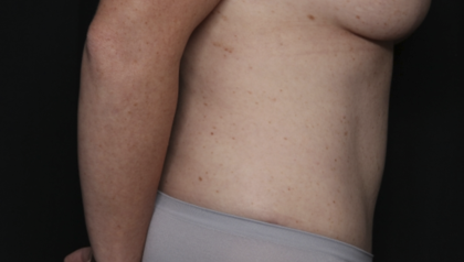 Tummy Tuck Before & After Patient #36585
