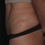 Liposuction Before & After Patient #36488