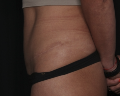 Liposuction Before & After Patient #36488