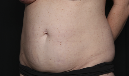 Tummy Tuck Before & After Patient #36585