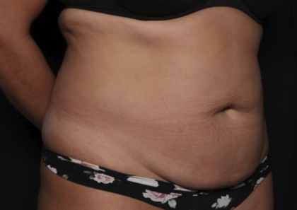 Liposuction Before & After Patient #36488