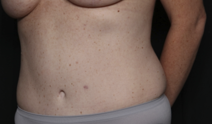 Tummy Tuck Before & After Patient #36585