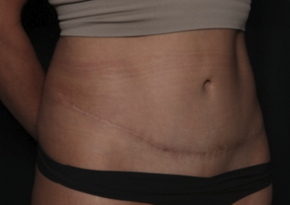 Liposuction Before & After Patient #36488