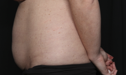 Tummy Tuck Before & After Patient #36585