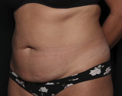 Liposuction Before & After Patient #36488