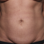 Liposuction Before & After Patient #36492