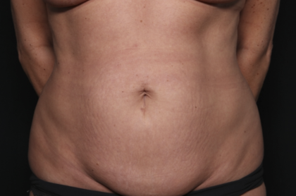 Liposuction Before & After Patient #36492
