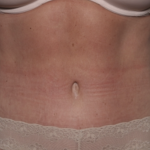 Liposuction Before & After Patient #36492
