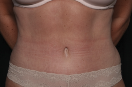 Liposuction Before & After Patient #36492