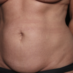 Liposuction Before & After Patient #36492