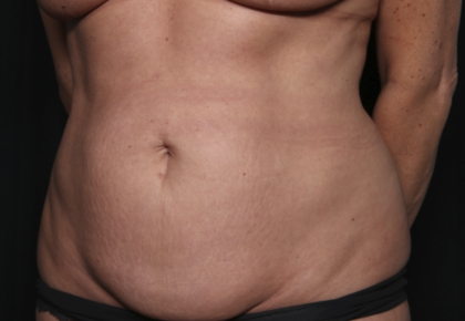 Liposuction Before & After Patient #36492