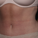 Liposuction Before & After Patient #36492