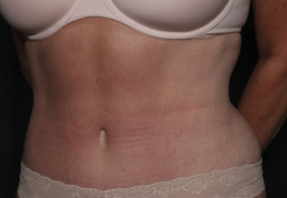 Liposuction Before & After Patient #36492