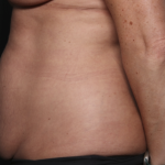 Liposuction Before & After Patient #36492