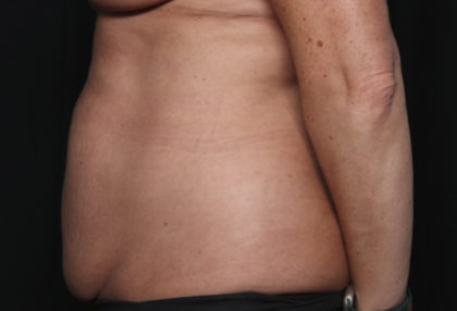 Liposuction Before & After Patient #36492