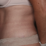 Liposuction Before & After Patient #36492