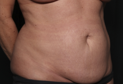 Liposuction Before & After Patient #36492