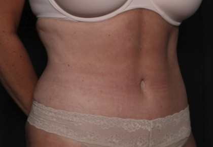 Liposuction Before & After Patient #36492