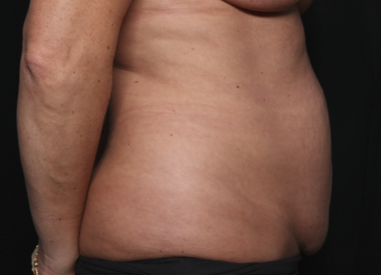 Liposuction Before & After Patient #36492